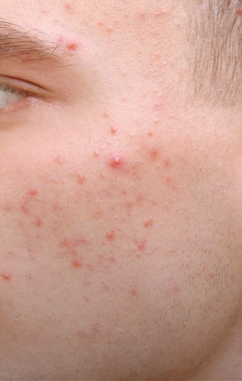 Acne