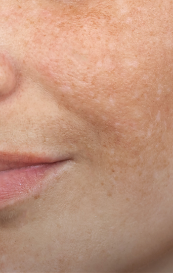 Pigmented Lesions