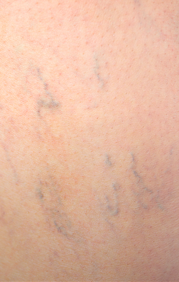 Vascular Lesions